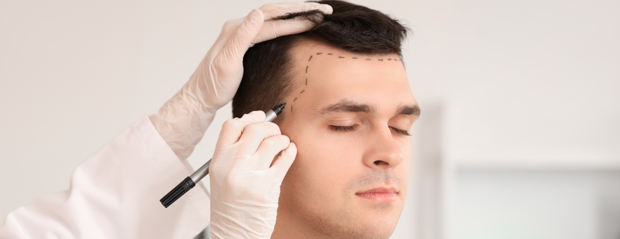 Myths and Truths About Hair Transplants: What You Need to Know